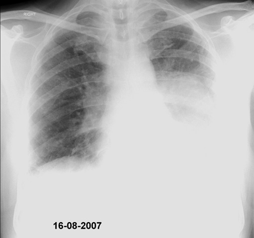 x rays of lung cancer. Chest X-ray 16/08/2007 This is